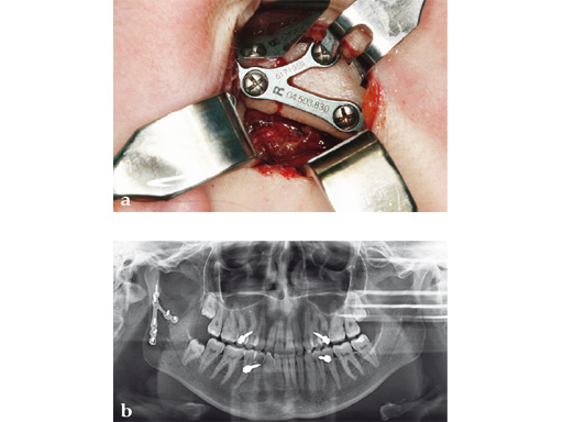 Fracture-Plates-Condylar-Neck-Base-08