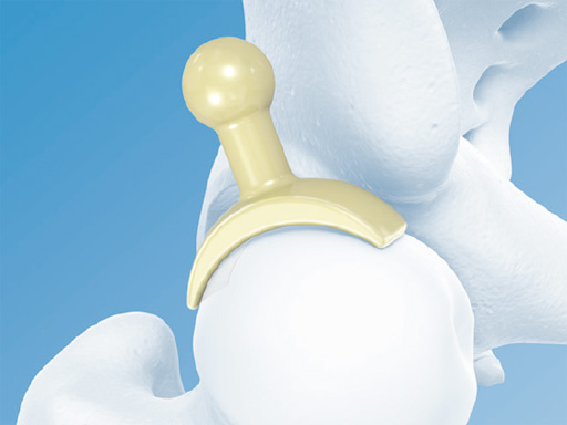 Hip-Preservation-Surgery-Set-02