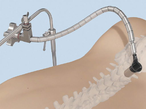 Insight-Retractor-Tube-Systems-02