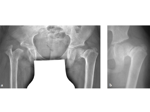 LCP-PHP-140-3_5-5_0-03