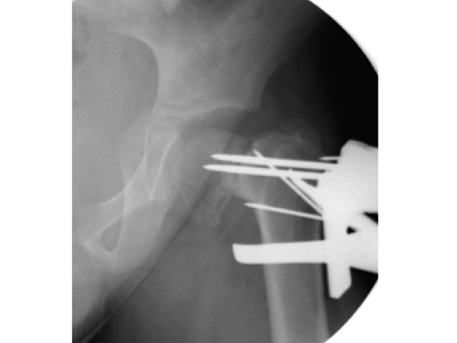 LCP-PHP-140-3_5-5_0-04