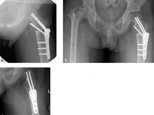 LCP-PHP-140-3_5-5_0-05