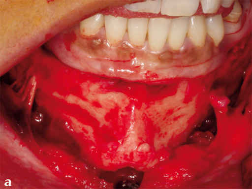piezoelectric-bone-surgery-system-05