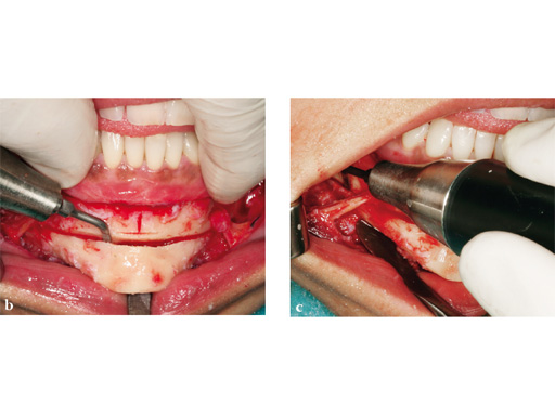 piezoelectric-bone-surgery-system-06