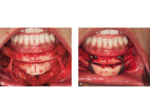 piezoelectric-bone-surgery-system-07