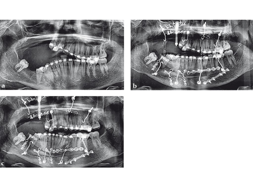piezoelectric-bone-surgery-system-08