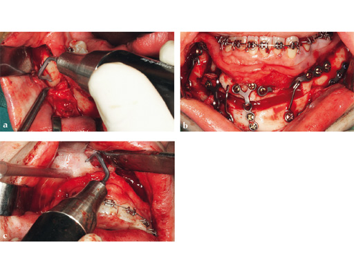 piezoelectric-bone-surgery-system-09