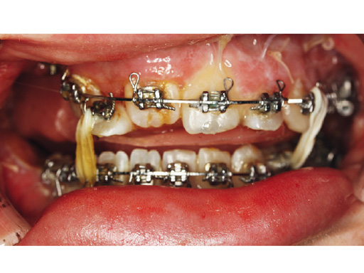 piezoelectric-bone-surgery-system-10