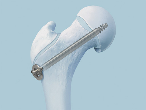 SCFE-Screw-System-01