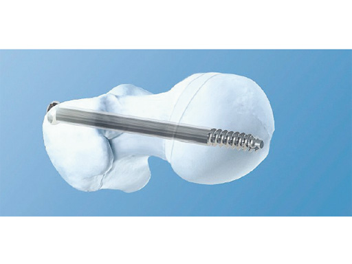 SCFE-Screw-System-02