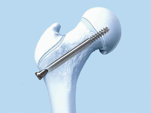 SCFE-Screw-System-03