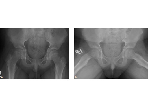 SCFE-Screw-System-06