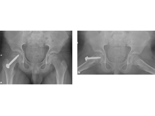 SCFE-Screw-System-07