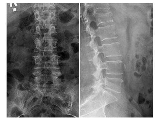 uss-fractures-case-a