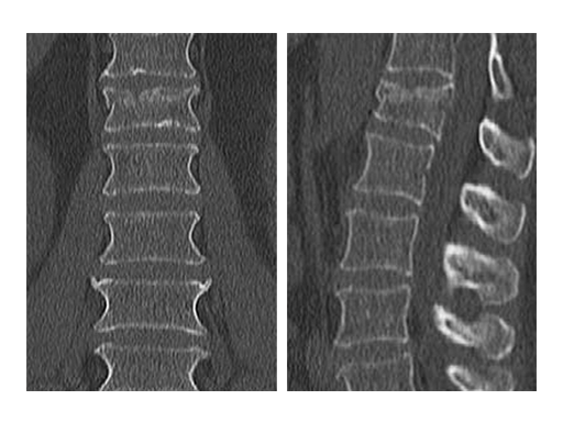 uss-fractures-case-b