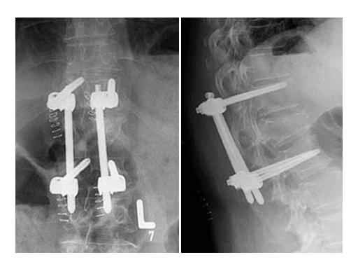 uss-fractures-case-e