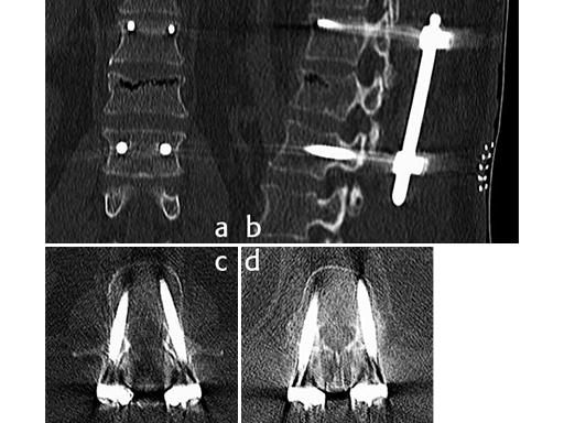 uss-fractures-case-f