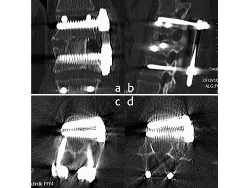 uss-fractures-case-i