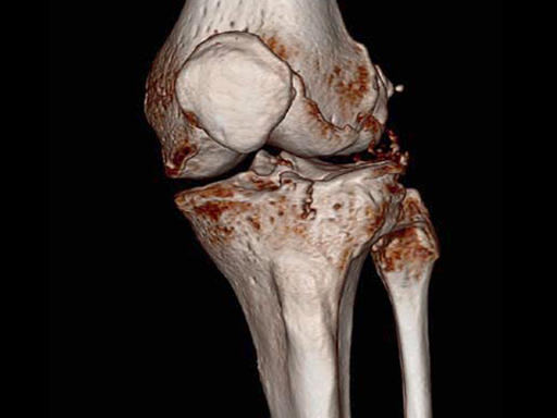 VA--LCP-Proximal-Tibial-Plate-5