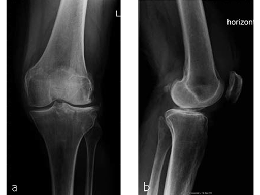 VA--LCP-Proximal-Tibial-Plate-6