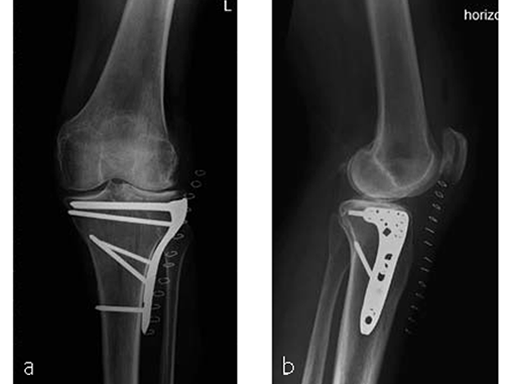 VA--LCP-Proximal-Tibial-Plate-7