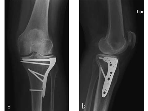 VA--LCP-Proximal-Tibial-Plate-8