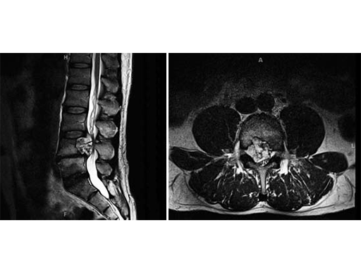 xrl-vertebral-case-a
