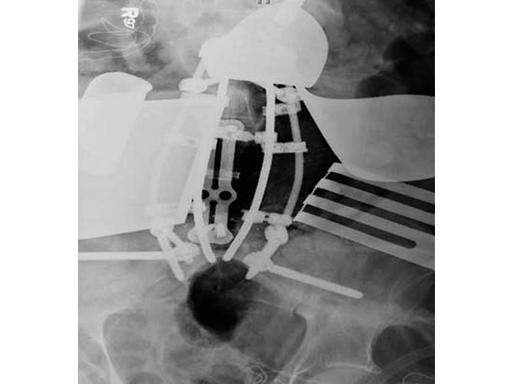 xrl-vertebral-case-b