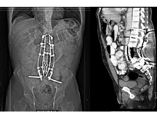 xrl-vertebral-case-c