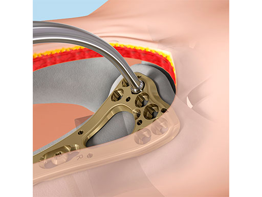 04_Soft-Tissue-Bone-Forceps_Fig_4