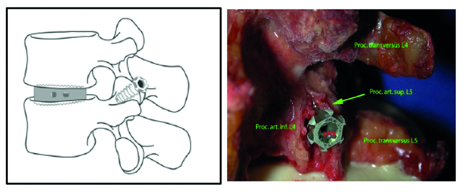 FacetwedgeFig_4ab Fig 4ab Facet interference screw.