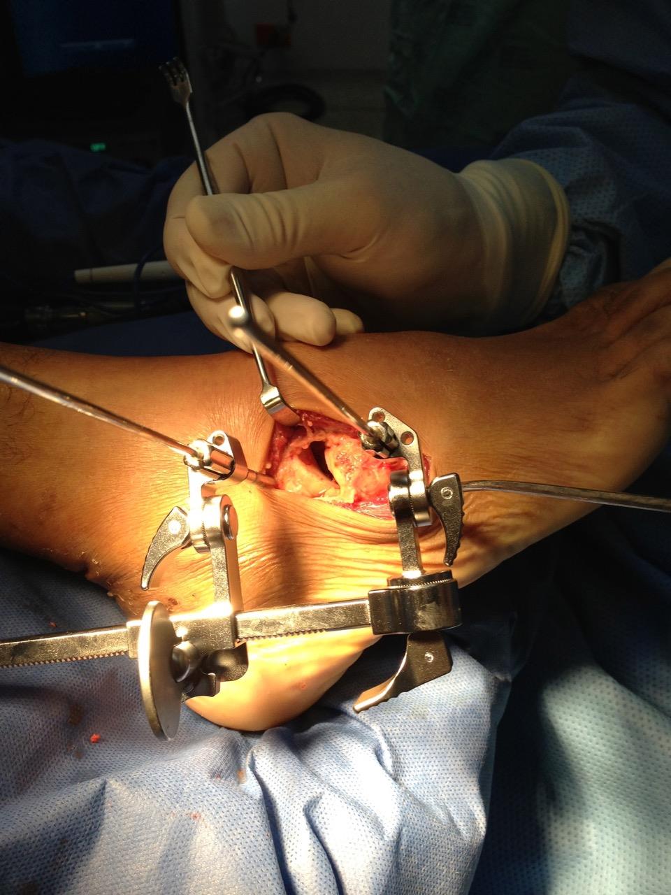 Gerstner-Compression-DistractionDevice