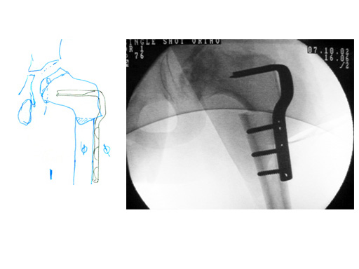 90_toddler_osteotomy_plate_3