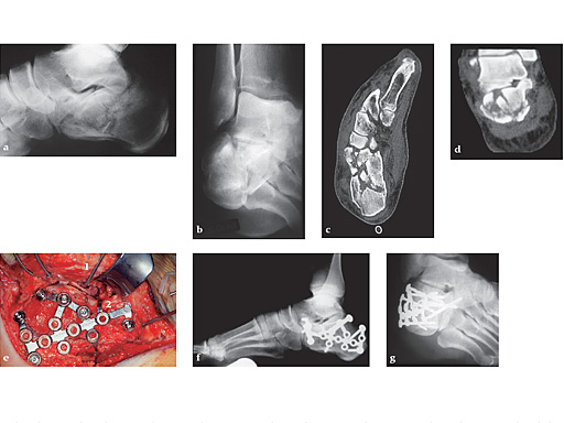 calcaneul-plate-case