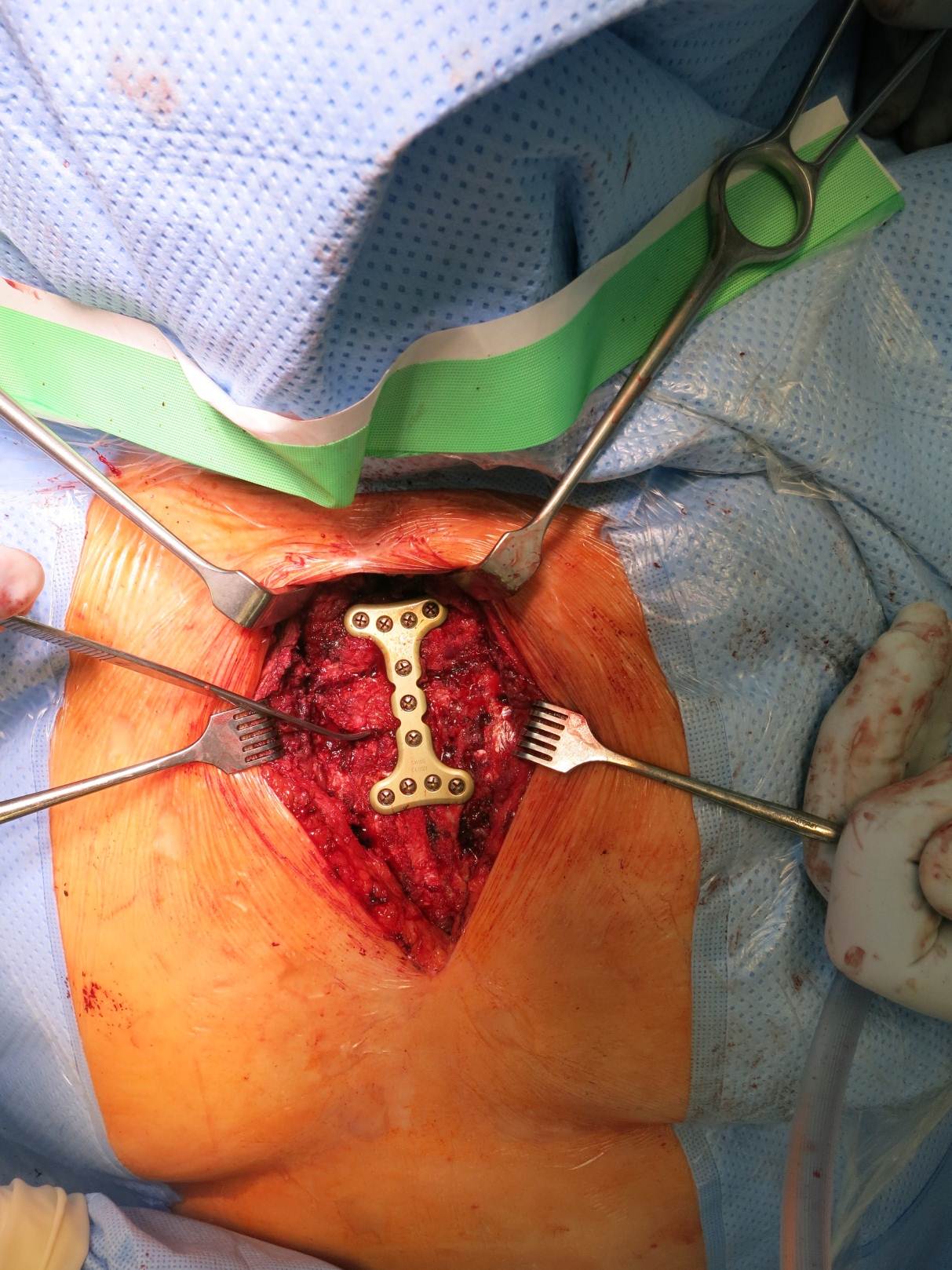Fig 8a: Intraoperative view - fixation 'all in one' with I-plate (during MPE) This specific plate has now been recalled and re-designed.