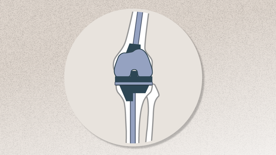 AO Recon Curricula_Complex Total - Knee