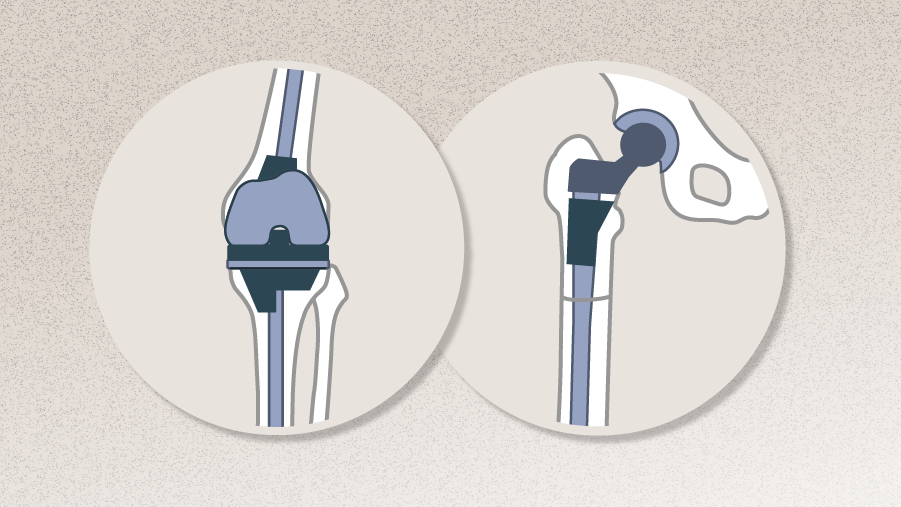 Complex Total Hip and Knee