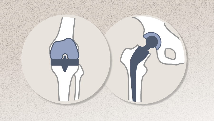 Principles of Total Hip and Knee