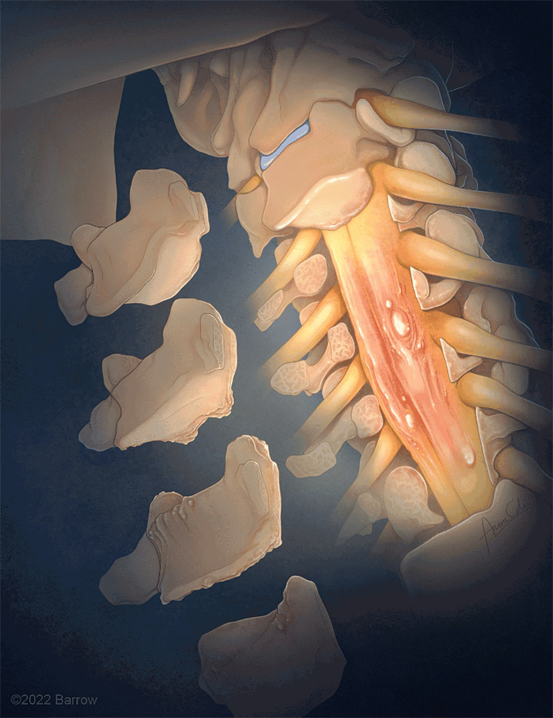 ©Barrow. Used with permission from Barrow Neurological Institute, Phoenix, AZ