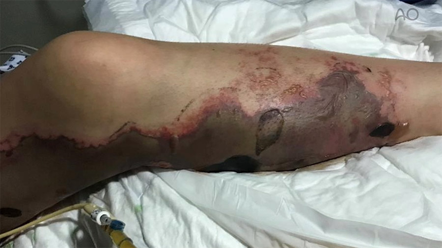 Necrotizing Fasciitis