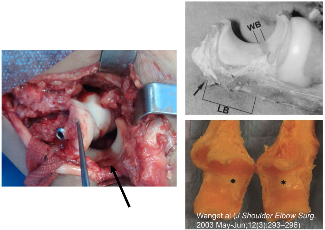 Distal humeral fractures
