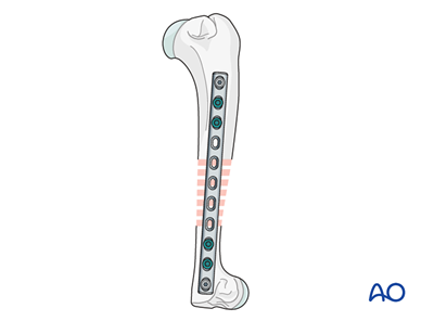AO Surgery Reference